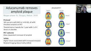 What’s New in Alzheimer’s Disease Clinical Trials?