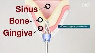 What is sinus lift and what is the DIOnavi sinus protocol?