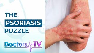 Psoriasis: Know the Symptoms, Causes, and available Treatments from Dermatology Specialist