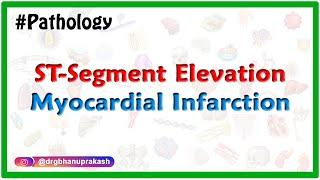 Complications of ST-segment elevation myocardial infarction (STEMI)