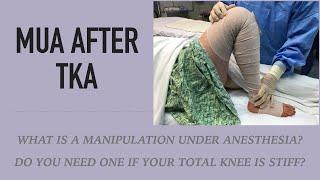 Manipulation Under Anesthesia (MUA) after Total Knee - Treatment for Stiffness