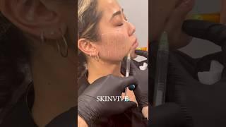 What Makes SKINVIVE the Best New Treatment?