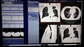 HRCT CHEST FILMING ON GE 16 SLICE MACHINE