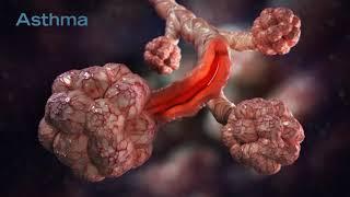 Asthma Causes & Treatment Video Animation