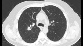 Right Upper Lobe Lung Mass