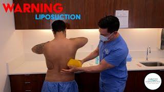 Liposuction performed on Flanks!