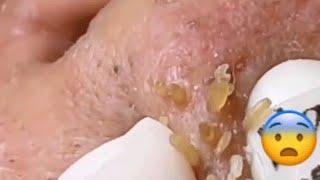 WOOW !! BEAUTY OF SQUEEZE BLACKHEADS REMOVAL FROM THE NOSE #relaxing  #blackheads