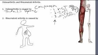 What Causes Arthritis?  It's Not Age, Genes, Or Magic