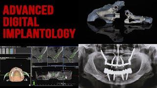 All on 5 hybrid Zygomatic (Jdental)