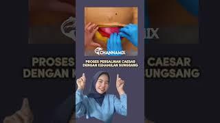 Proses Melahirkan Caesar - Medikacare