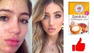 How to get rid of acne? | Yeast face mask