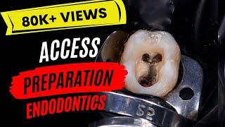 Access Preparation in Endodontics | Guest Lecture