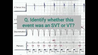 Device interrogation quiz ll VT or SVT?