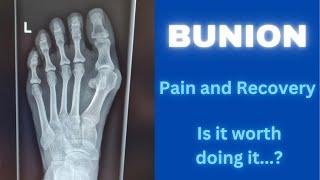 Minimally Invasive Bunion Surgery | Pain and Recovery Day by Day for the first 3 weeks