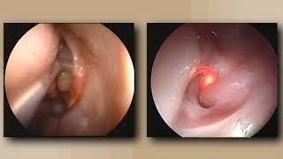 Step by Step Maxillary Dilation DNB ENT OSCE Video Station DnbMentors