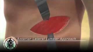 Anterior Lateral Lumbar Approach