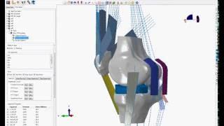 SIMULIA Abaqus Knee Simulation