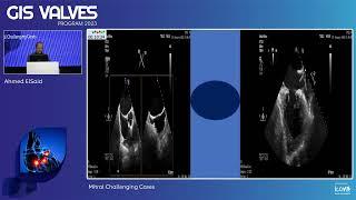 13  Mitral Challenging Cases   Ahmed el said