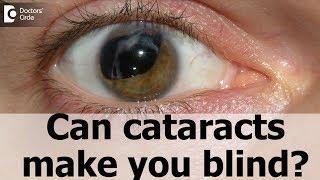 Can cataracts make you blind? - Dr. Sriram Ramalingam
