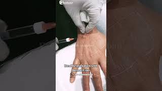 HAND REJUVENATION WITH DERMAL FILLERS.