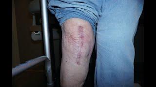 6 Week Follow Up Revision Knee Replacement Doing Great | Dr. Robert Cagle