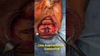 Marking and Planning of Chin Contouring Augmentation Surgery from the Operating Room! #shorts