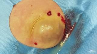 Cyst Squeezed to The Last Blob
