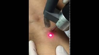 Leg Vein Laser by Dr. Taj Khan