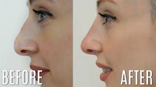 5 Minute Nose Job - Non-surgical Rhinoplasty | Carly Musleh