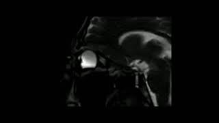 Keratoconus Eye rubbing MRI Keratocone frottements oculaires IRM