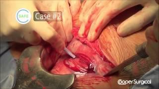 C SAFE Surgical Cases