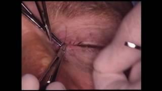 Repair of canalicular laceration with a pigtail probe HD