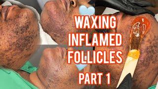 Waxing Inflamed Follicles Part 1 | NEW Client Alert! This Is #Hirsutism