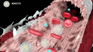 Development of atherosclerosis