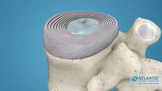 What is Cervical Disc Herniation? @AtlanticSpineCenter