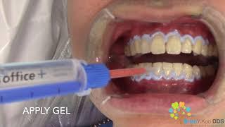 In-Office Teeth Whitening (1 round out of 3)