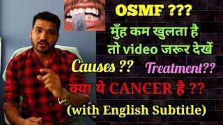 मुँह कम खुलने के कारण और इलाज | Oral submucous fibrosis Causes and Treatment