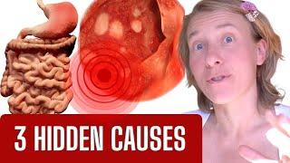 What REALLY Causes Gastritis?