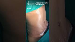 Results of Liposuction with Tummy Tuck Surgery | Dr Karishma Aesthetics #liposuctionresults #shorts