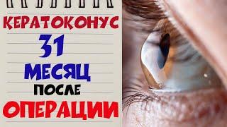  КЕРАТОКОНУС ‍️ Спустя 31 МЕСЯЦ после кератотомии в клинике Арцыбашева в Будапеште 