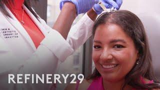 I Tried PRP For Hair Restoration | Macro Beauty | Refinery29