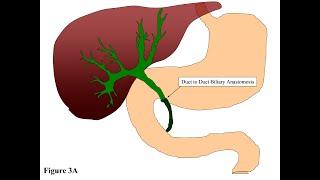 Biliary Stricture Symptoms and Causes - Diagnosis - Treatment - Prevention