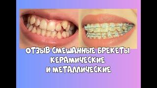 Отзыв смешанные брекеты керамические и металлические, в АСТ Студия, ортодонт Асташина Юлия Борисовна