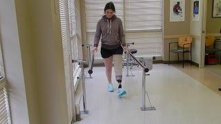 First Time Walking with Prosthetic Leg!