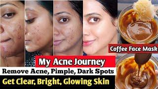 I used Coffee face pack for remove Acne pimple dark spots free skin/ coffee face mask skin whitening