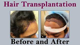 Female Hair Transplant Before and After | 2,000 Grafts |Dr VJs Cosmetic Surgery Hair Transplantation