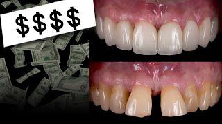 $80,000 for Veneers?! 