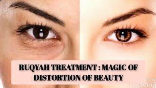Ruqyah Treatment: Distortion of Beauty Due To Black Magic, Evil Eye, Envy