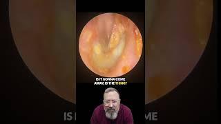 INSANE Ear Wax Removal! Thick Layers Pulled Out 