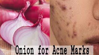 Onion for Acne Marks | DEMO |